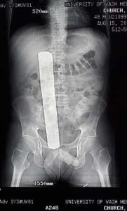 X-ray of Surgical Object