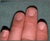 Alopecia Areata Nails